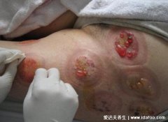 带状疱疹治疗偏方大全用法，火针加拔罐剧