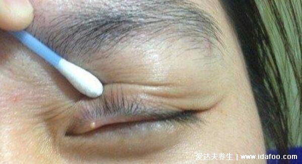 麦粒肿怎么消除快,3个简单快速消除的方法(附图片症状)