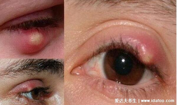 麦粒肿怎么消除快,3个简单快速消除的方法(附图片症状)