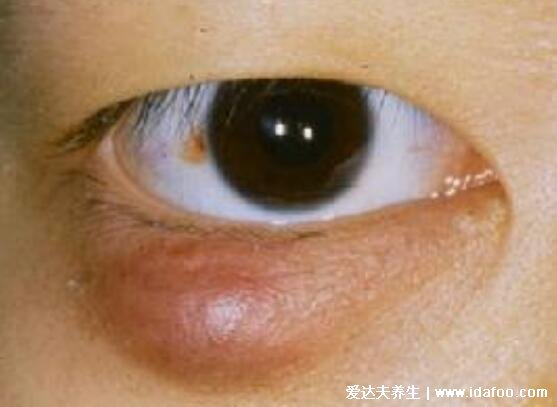 麦粒肿早期图片症状及怎么消除,俗称针眼可使用抗生素消除