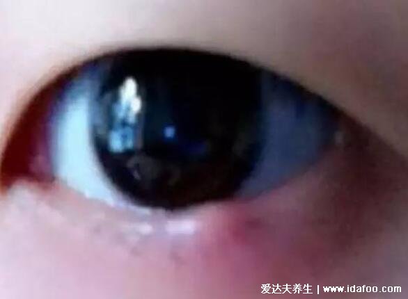 麦粒肿早期图片症状及怎么消除,俗称针眼可使用抗生素消除