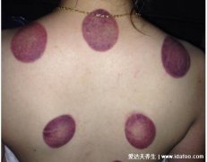 拔罐黑紫色说明什么原因及好处，变黑后调