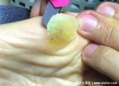 鸡眼挖出来的肉刺图，呈白色粉丝状为全部