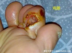 长鸡眼是什么原因造成的，多为长期受到摩