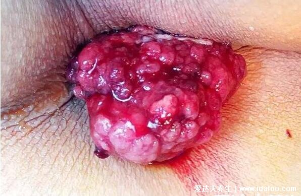 轻度痔疮最佳的自愈方法,4种方法不用手术不担心复发(图片)