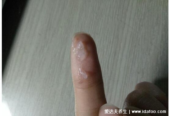 女孩初潮前的白带图片,颜色多为巧克力色伴随有血丝