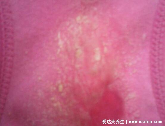 女孩初潮前的白带图片,颜色多为巧克力色伴随有血丝