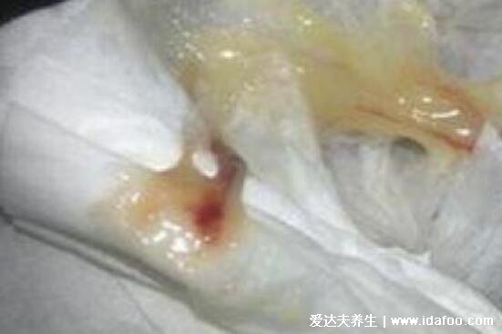 女孩初潮前的白带图片,颜色多为巧克力色伴随有血丝