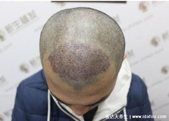 5000个毛囊植发的价格,大约需要一万元以上(附价格介绍)