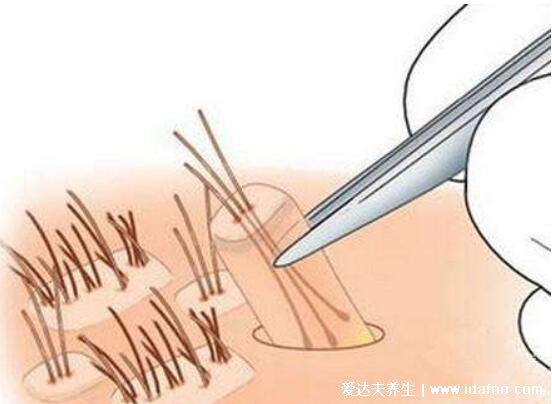 5000个毛囊植发的价格,大约需要一万元以上(附价格介绍)