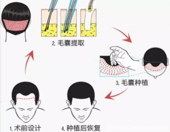 5000个毛囊植发的价格,大约需要一万元以上(附价格介绍)