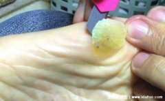 鸡眼怎么去除最好方法，除了用鸡眼贴还有