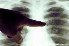 抽了一年电子烟的肺部图片,与普通香烟对