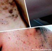 艾滋两周绝对有的症状图片,皮疹痒与淋巴