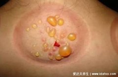 艾灸后怎么看湿气排出,除水泡还有这四个