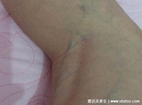 早期小腿静脉曲张图片及症状,可见明显血管扩张有瘙痒感