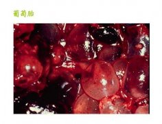 葡萄胎是什么及形成原因与症状，与葡萄相