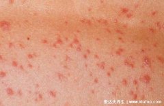 白血病初期小红点图片，多为颜色鲜红针尖
