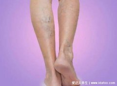 早期小腿静脉曲张图片及症状，可见明显血