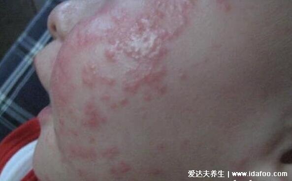 小儿湿疹图片及症状,干燥型湿疹最痒不要搔抓