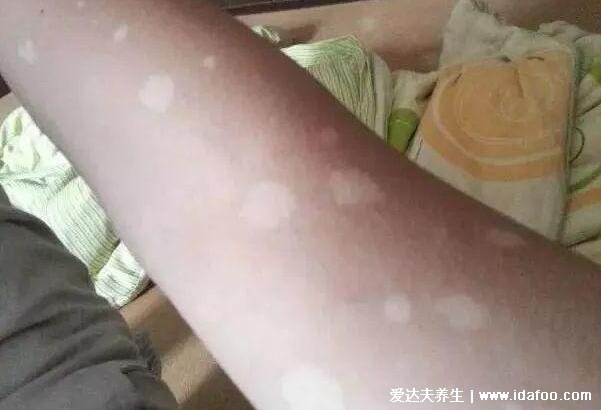 早期花斑癣图片及症状,大面积淡白色或褐色斑片影响美观