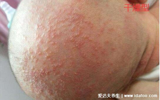 新生儿湿疹图片症状及护理方法,呈明显红肿有强烈瘙痒感