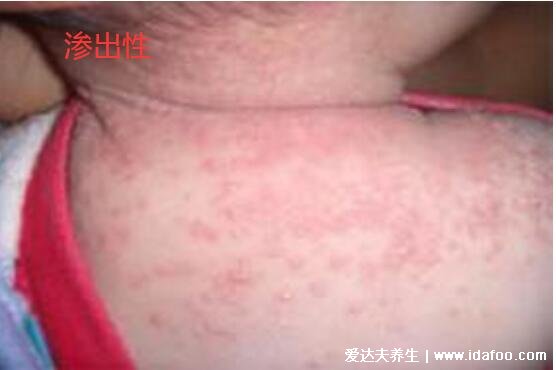 新生儿湿疹图片症状及护理方法,呈明显红肿有强烈瘙痒感