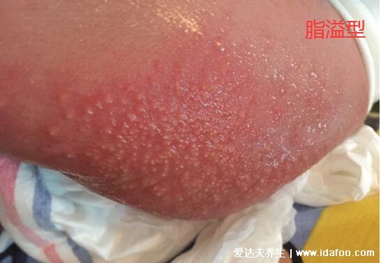 新生儿湿疹图片症状及护理方法,呈明显红肿有强烈瘙痒感