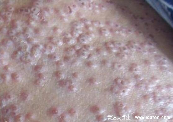 新生儿湿疹图片症状及护理方法,呈明显红肿有强烈瘙痒感