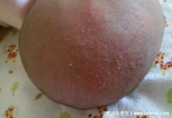 新生儿湿疹图片症状及护理方法,呈明显红肿有强烈瘙痒感