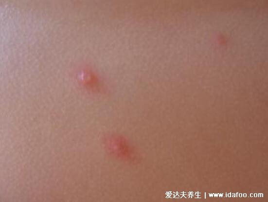 水痘早期图片大全,有类似症状则注意自我隔离