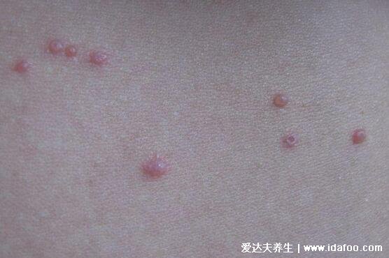 水痘早期图片大全,有类似症状则注意自我隔离