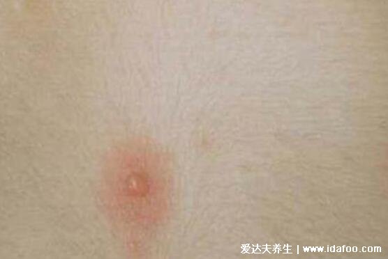 水痘早期图片大全,有类似症状则注意自我隔离