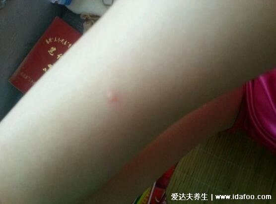 水痘早期图片大全,有类似症状则注意自我隔离