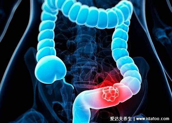 4个最为明显的肠癌信号,大便变细带血不规律都有可能是肠癌
