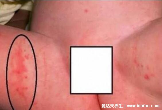 尿布疹图片症状及注意事项,俗称红屁股分为三个阶段