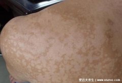 早期花斑癣图片及症状,大面积淡白色或褐