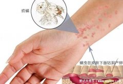 床上螨虫咬的症状图片,皮肤出现红色丘疹