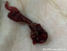 药流后孕囊掉下来的图片,呈椭圆形乳白色