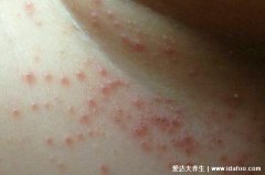 婴儿痱子症状图片,三种症状的痱子和湿疹