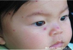 水痘早期图片大全，有类似症状则注意自我