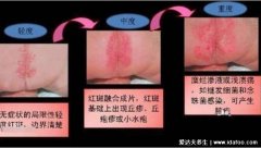 尿布疹图片症状及注意事项,俗称红屁股分