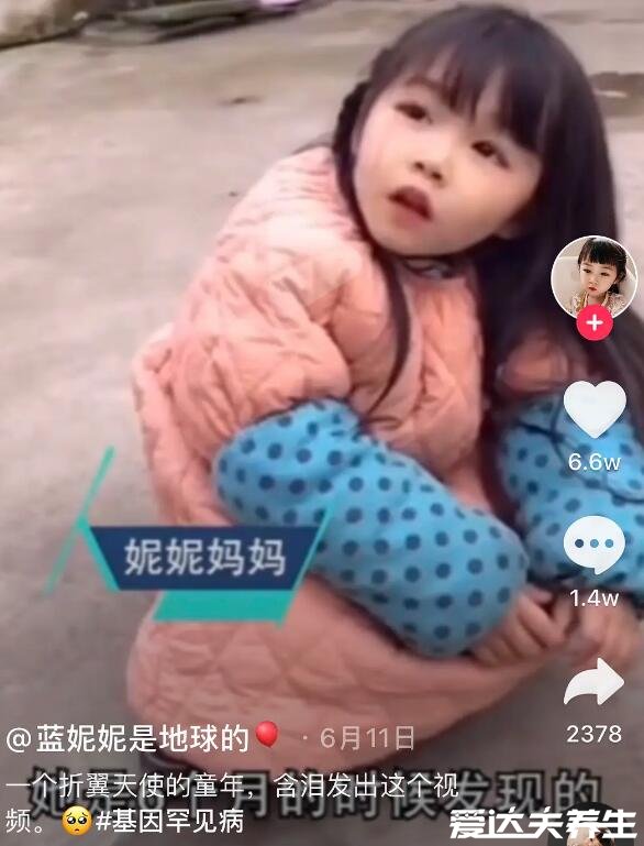 罕见的歌舞伎面谱综合症,长得太好看也是一种绝症