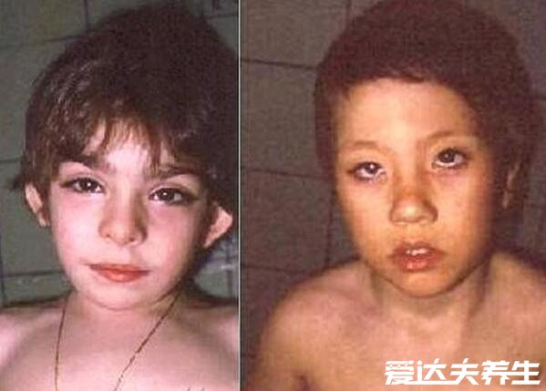 罕见的歌舞伎面谱综合症,长得太好看也是一种绝症