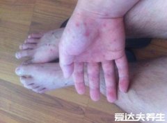 梅毒小红点早期图,从生殖部位扩散到全身