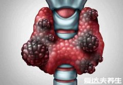 四种癌已经不是癌了,甲状腺癌为“幸福癌