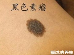 黑色素瘤早期症状图片,通过abcd法轻松辨别