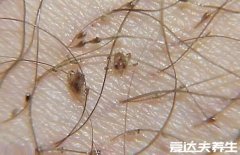 私处长阴虱虫子图片，有这4大症状需要警惕