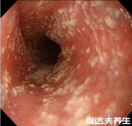 感染后的白色念珠菌图片,呈豆渣样分泌物