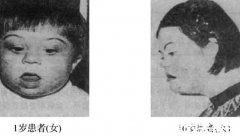 超雌综合症患者特别漂亮是其次，还伴随智